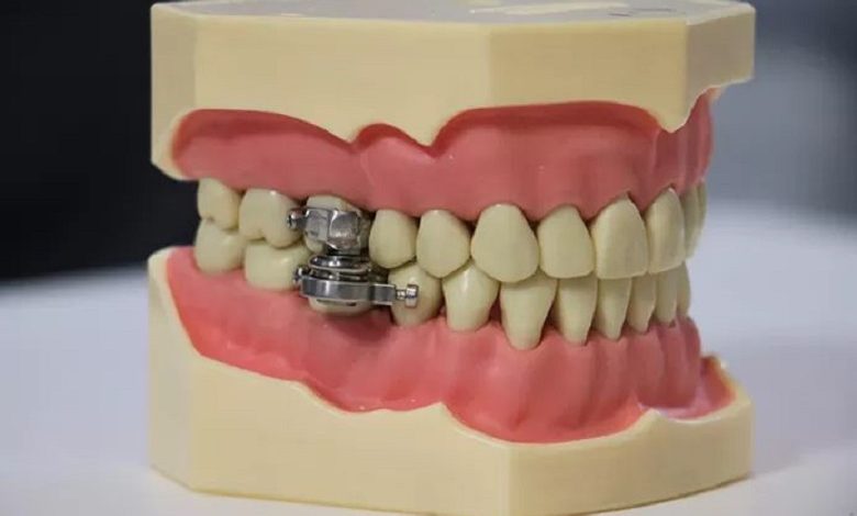 Mouth torture or weight loss? This device clenches jaws for diet