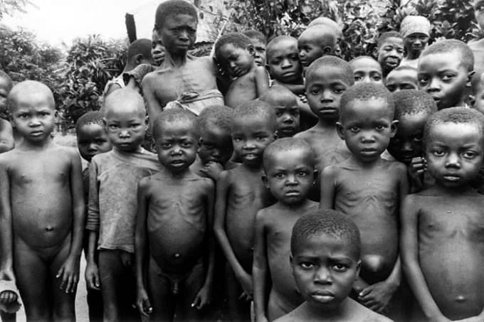 Malnourished Biafran children during the war