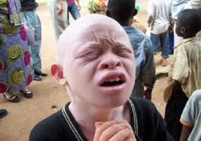 Why are Albinos killed in Africa?