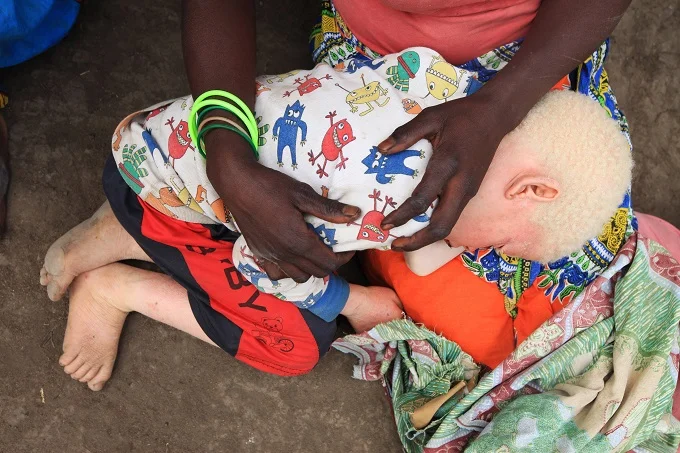 Why are Albinos killed in Africa?