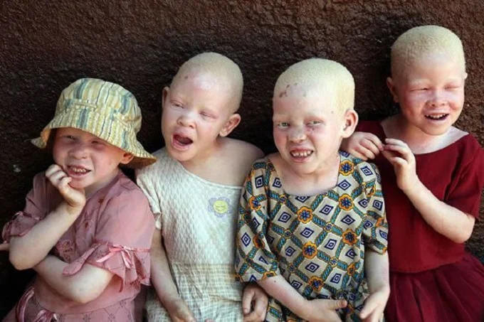 Children with albinism