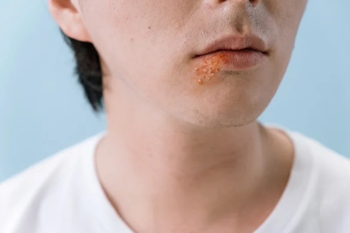 How to get rid of herpes on the lips in 1 day: 7 alternative methods