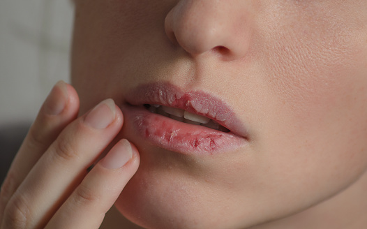 Why lips dry and how to care for them in the cold season
