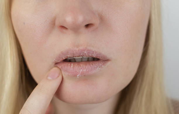 Why lips dry and how to care for them in the cold season