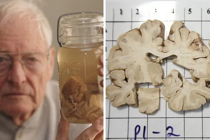 Einstein's brain was cut into 250 pieces and stored in a jar in the basement