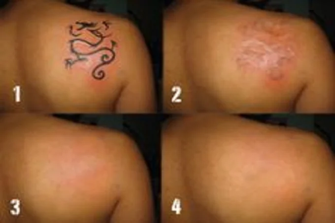 Best tattoo removal methods