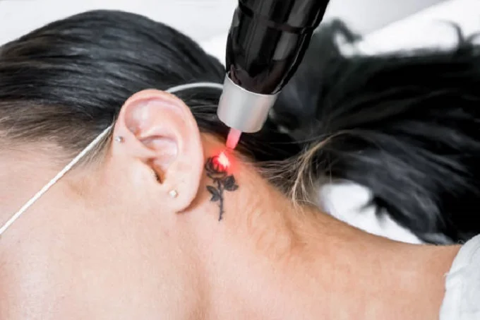 Best tattoo removal methods