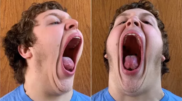 Philip Angus, world record 'biggest mouth' at sixteen.
