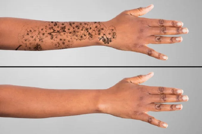 Best tattoo removal methods