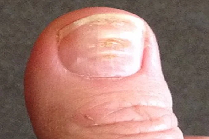 Fingernail ridges: What causes furrows on the nails, and how to get rid of them