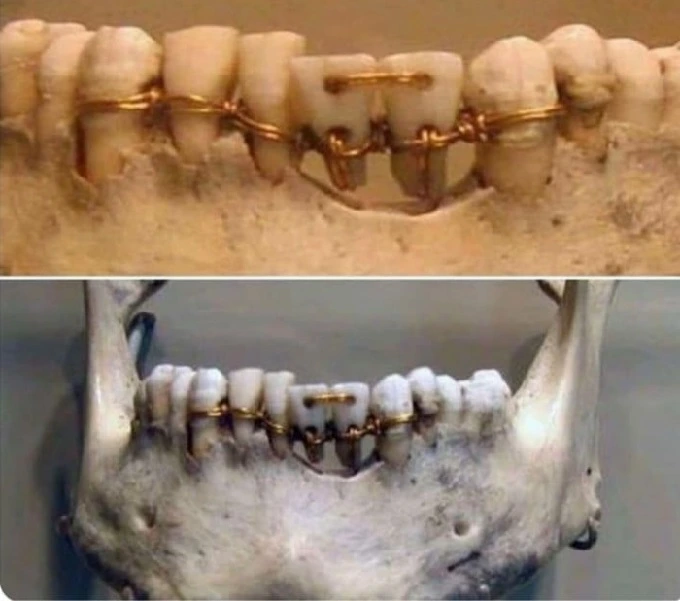 Dentistry in ancient Egypt